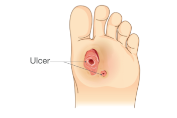 Don’t ignore foot ulcers!
