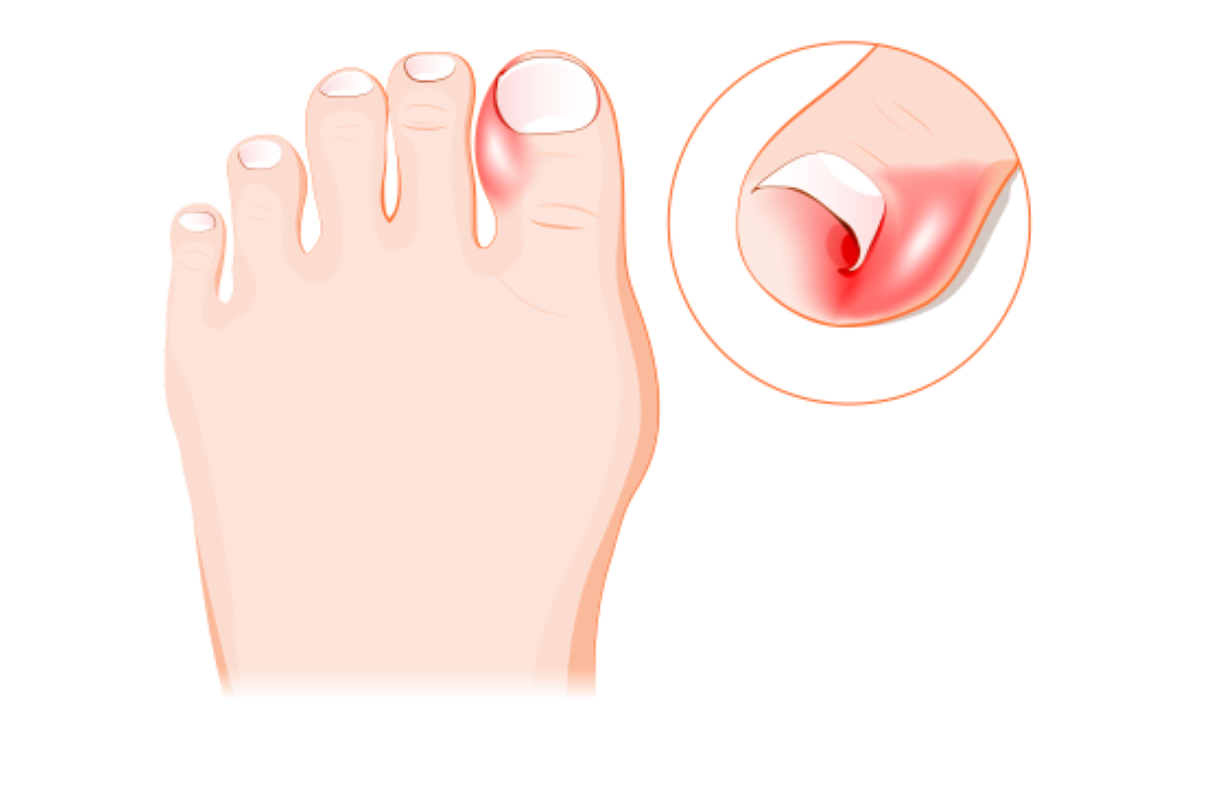 Oh, my aching toe!