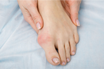 How to treat bunions